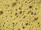 Alzheimer's Disease Brain Section Showing Both Neurofibrillary Tangles and Plaques, LM Photographic Print by Thomas Deerinck