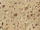 Alzheimer's Disease Brain Tissue Showing Both Neurofibrillary Tangles and Plaques, LM Photographic Print by Thomas Deerinck