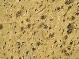 Alzheimer's Disease Brain Section Showing Both Neurofibrillary Tangles and Plaques, LM Photographic Print by Thomas Deerinck