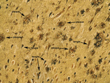 Alzheimer's Disease Brain Tissue Section Showing Both Neurofibrillary Tangles and Plaques, LM Photographic Print by Thomas Deerinck