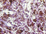 Melanotic Sarcoma in Human Heart Muscle, LM Photographic Print by Ralph Hutchings