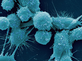 Human Prostate Cancer Cells, SEM Photographic Print by Gopal Murti