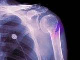 Complete Fracture of Humeral Neck Photographic Print by Charles McRae