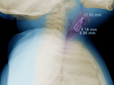 X-Ray Showing a Barrette in the Trachea of a 10 Month Old Baby Photographic Print by Chuck Swartzell