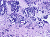 Corpus Callosum Section Showing Metastatic Oat Cell Carcinoma of the Lung, H&E Stain, LM X20 Photographic Print by Frederick Skarva