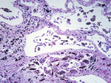 Asbestos in the Human Lung Showing Interstitial Fibrosis, LM X50 Photographic Print by Frederick Skarva