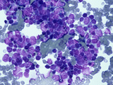 Bone Marrow Showing Metastatic Oat Cell Carcinoma of the Lung, Wright/Giemsa Stain, LM X125 Photographic Print by Frederick Skarva