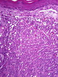 Kaposi's Sarcoma in a Human Skin Section, H&E Stain, LM X50 Photographic Print by Frederick Skarva