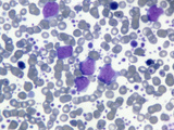 Blood Smear of Acute Myeloid Leukemia, Peripheral Blood, LM X200 Photographic Print by Arthur Siegelman