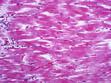 Myocardial Infarction Section, Early Coagulation Necrosis with Few Polyps, LM X70 Photographic Print by Frederick Skarva