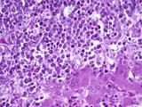 Malignant Lymphoma or Non-Hodgkins Lymphoma in the Liver, H&E Stain, LM X125 Photographic Print by Frederick Skarva