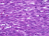 Kaposi's Sarcoma in the Skin of an Aids Patient, H&E Stain, LM X125 Photographic Print by Frederick Skarva