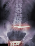 Colored X-Ray of Fractures Fixed by Screws and Plates Photographic Print by Charles McRae