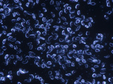 Human Blood from a Patient with Sickle Cell Disease, Homozygous Hemoglobin, Darkfield, LM X100 Photographic Print by Gladden Willis
