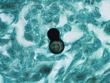 Budding Yeast of Blastomyces Dermatitidis Fungus in Human Skin Photographic Print by Gladden Willis