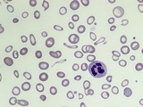 Blood from a Patient with Severe Iron Deficiency Anemia Photographic Print by Gladden Willis