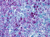 Blastomyces Dermatitidis Fungus in Mammal Lung Tissue, the Cause of North American Blastomycosis Photographic Print by Gladden Willis