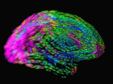 Human Brain Variation Purple Blur Represents Highest Variability from Subject to Subject Photographic Print by Arthur Toga
