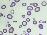 Blood from a Patient with Severe Iron Deficiency Anemia Photographic Print by Gladden Willis