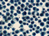 Adenocarcinoma of the Lung from an Elderly Woman Photographic Print by Gladden Willis
