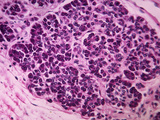 Cross-Section of the Pancreas from a Person with Diabetes Mellitus, LM X200 Photographic Print by Arthur Siegelman