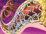 Stent in Coronary Artery of the Heart Photographic Print by Craig Zuckerman