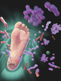 Foot Ulcer, Diabetics are Prone to Foot Ulcers, Due to Neurological and Vascular Complications Photographic Print by Craig Zuckerman