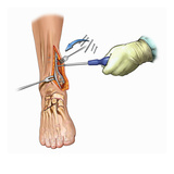 Biomedical Illustration of Medial Ankle Surgical Exposure and Maleollar Fracture Fixation Reproduction procédé giclée par  Nucleus Medical Art