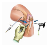 Biomedical Illustration of Parapatellar Stab Incisions (Portals) to Insert Arthroscopic Instruments Reproduction procédé giclée par  Nucleus Medical Art