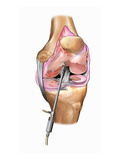 Illustration of Knee Arthroscopic Chondroplasty Procedure Giclee Print by  Nucleus Medical Art
