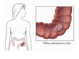 Biomedical Illustration of a Villous Adenoma Within a Cut-Away Front View of the Colon Giclee Print by  Nucleus Medical Art