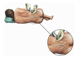 Epidural Nerve Block Injection Giclee Print by  Nucleus Medical Art