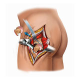 Illustration of Femoral Neck Cut for Placement of Prostheses for a Total Hip Replacement Procedure Giclee Print by  Nucleus Medical Art