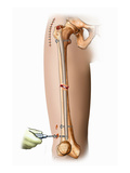 Illustration of Internal Fixation of Femur Fracture with an Intramedullay Rod in Place Giclee Print by  Nucleus Medical Art