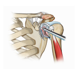 Biomedical Illustration of Shoulder Synovectomy and Labral Tear Debridement Giclee Print by  Nucleus Medical Art