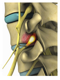 Biomedical Illustration of a Bony Tumor of the Vertebrae Compressing a Nerve Root Giclee Print by  Nucleus Medical Art