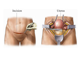 This Medical Exhibit Depicts Two Steps of an Abdominal Hysterectomy Procedure Giclee Print by  Nucleus Medical Art