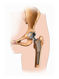 Biomedical Illustration of a Total Hip Replacement Giclee Print by  Nucleus Medical Art