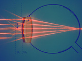 Parallel Rays of Light Enter a Nearsighted Eye with a Corrective Diverging Lens Photographic Print by  Scientifica