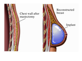 Illustrations of the Primary Reconstruction of the Breast Following a Total Mastectomy Giclee Print by  Nucleus Medical Art