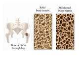 Illustration Depicting Osteoporosis Using Three Illustrations Giclee Print by  Nucleus Medical Art