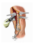 Biomedical Illustration of Osteotomy of the Femur Shaft for Lengthening the Leg Giclee Print by  Nucleus Medical Art