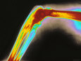 Digitized X-Ray Normal Elbow Photographie