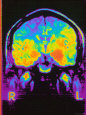 Magnetic Resonance Imaging MRI of Head Lámina fotográfica